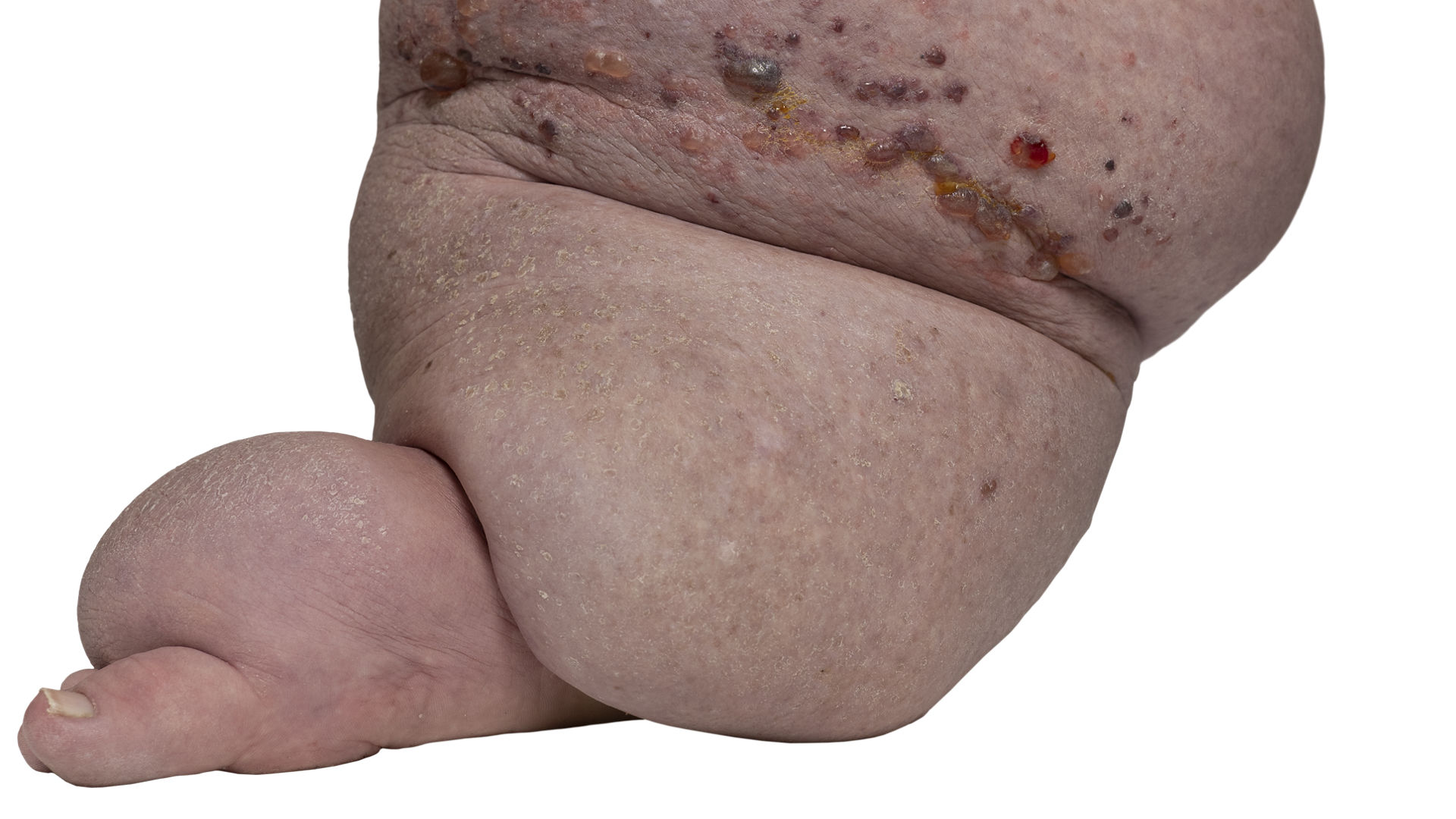 Elephantiasis  was ist das? Welche Hilfe fr Betroffene? | medi